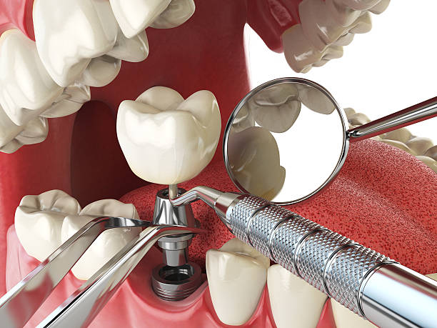 Best Emergency Dental Care for Broken or Chipped Teeth in Oak Grove, VA